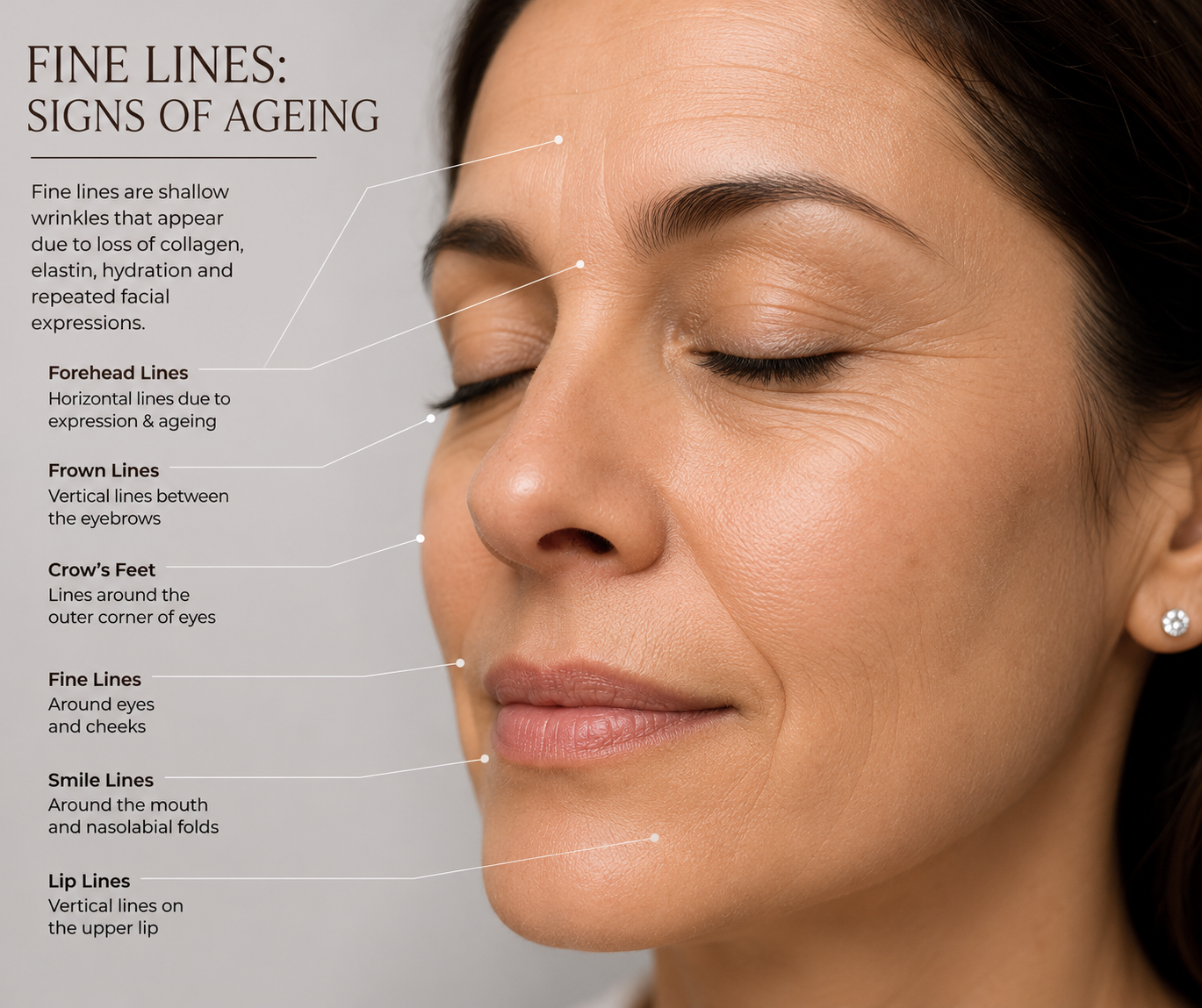 Fine lines — Surface