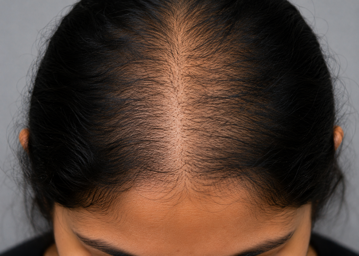 Androgenetic — Genetic, gradual