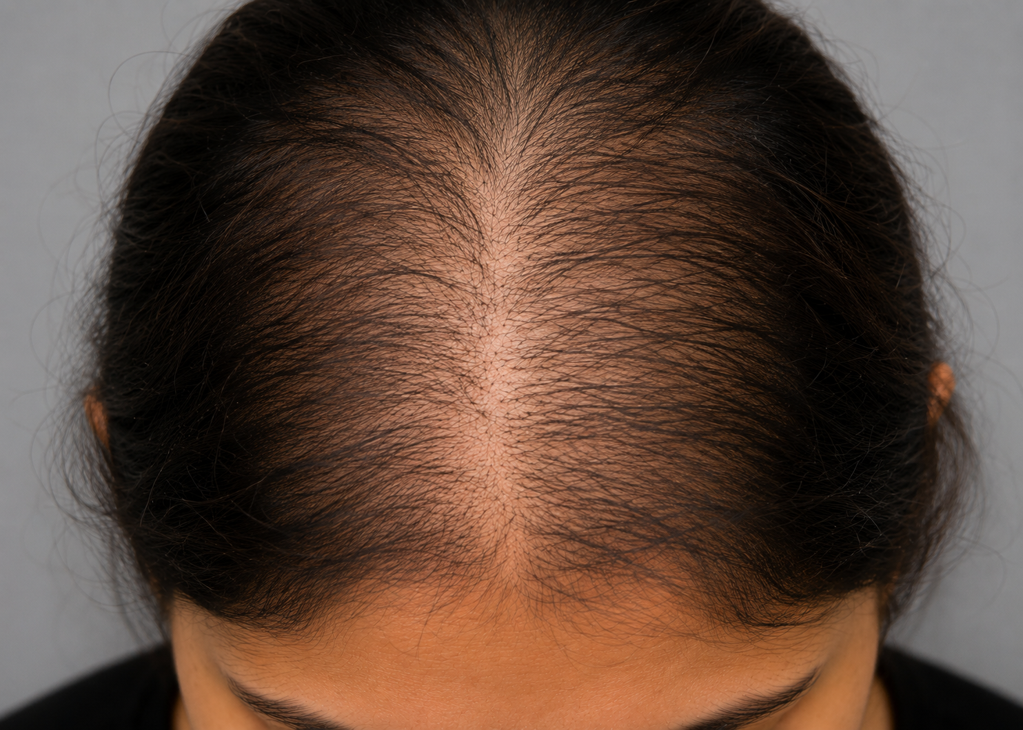 Telogen effluvium — Acute shedding