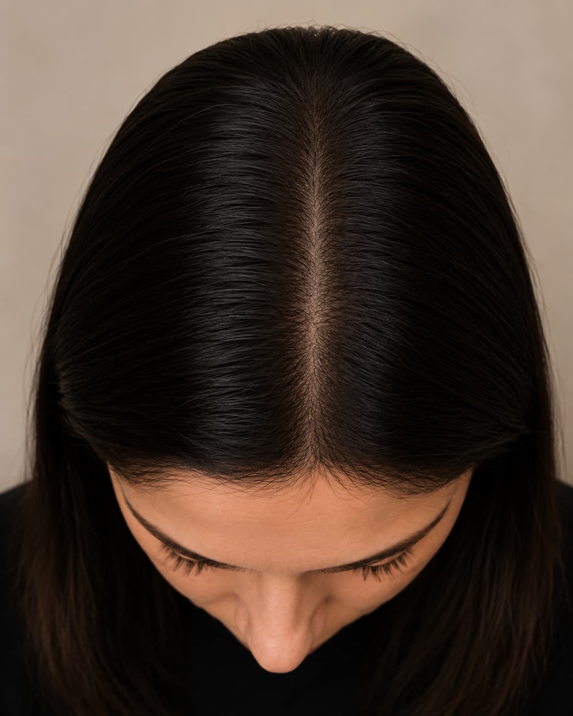 Case 03 · After — same parting, five months on