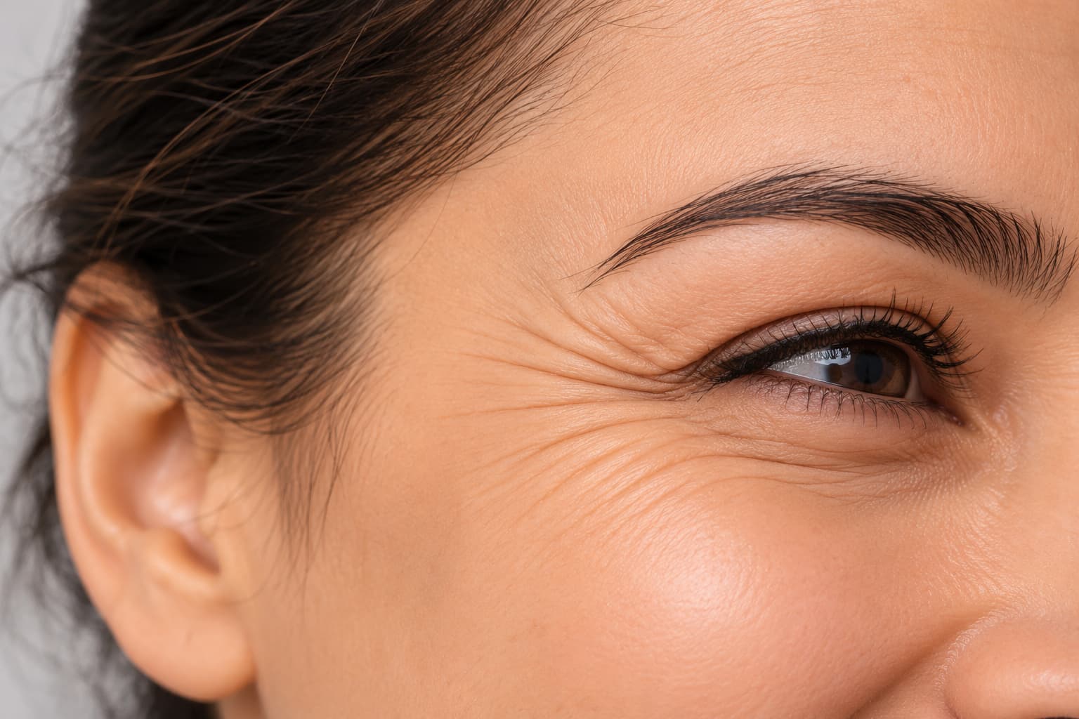 Botox treatment for crow’s feet