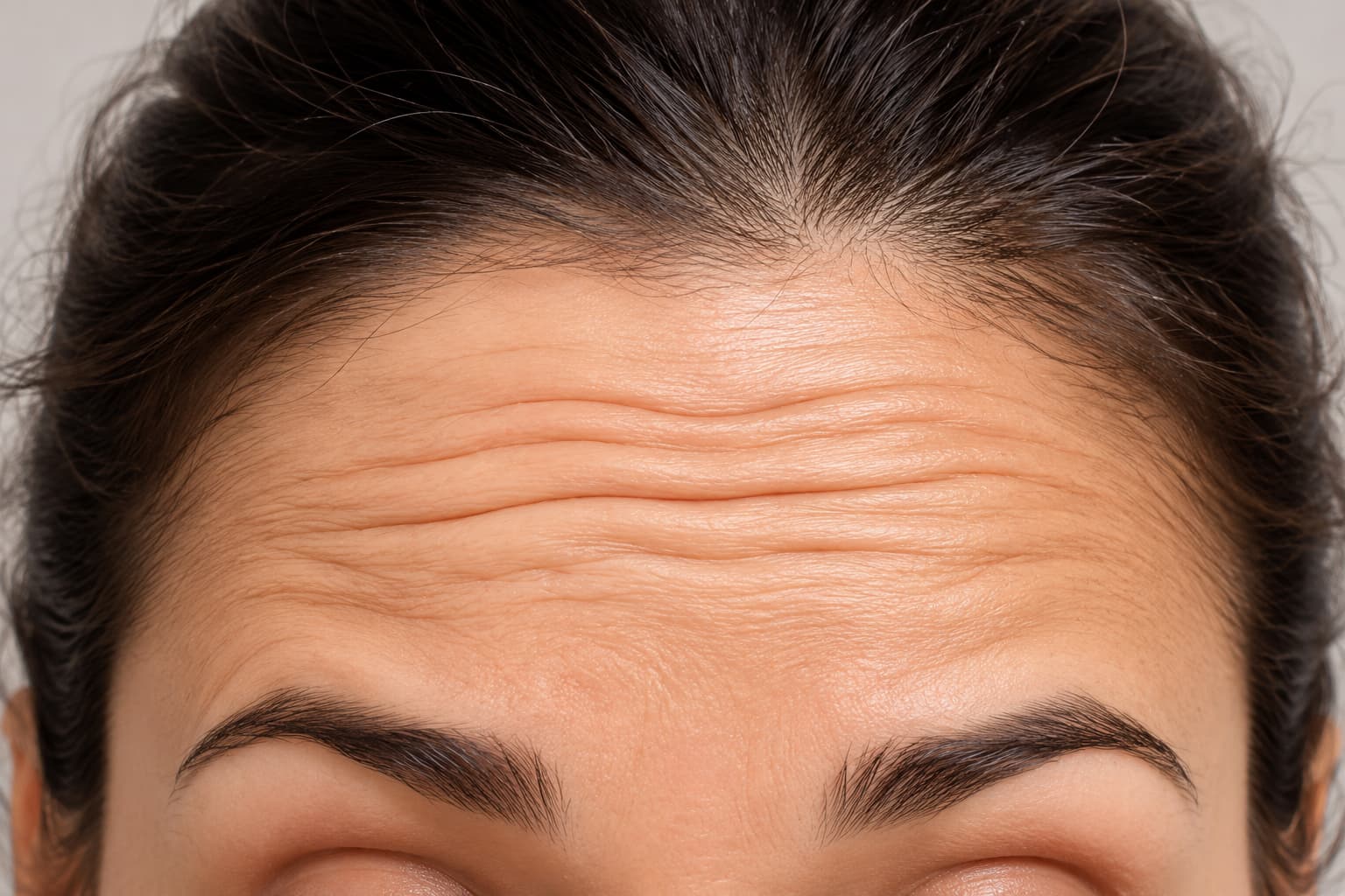Botox treatment for forehead lines
